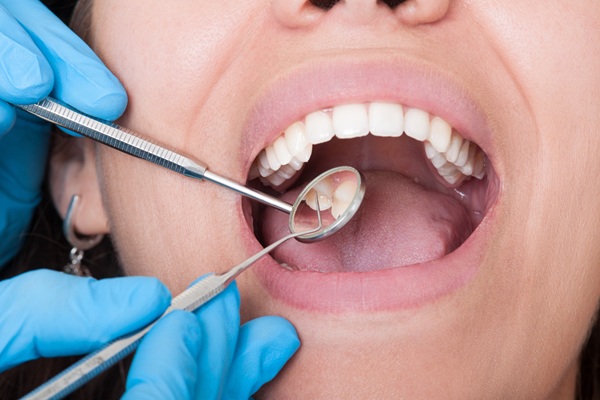 Types Of Dental Fillings