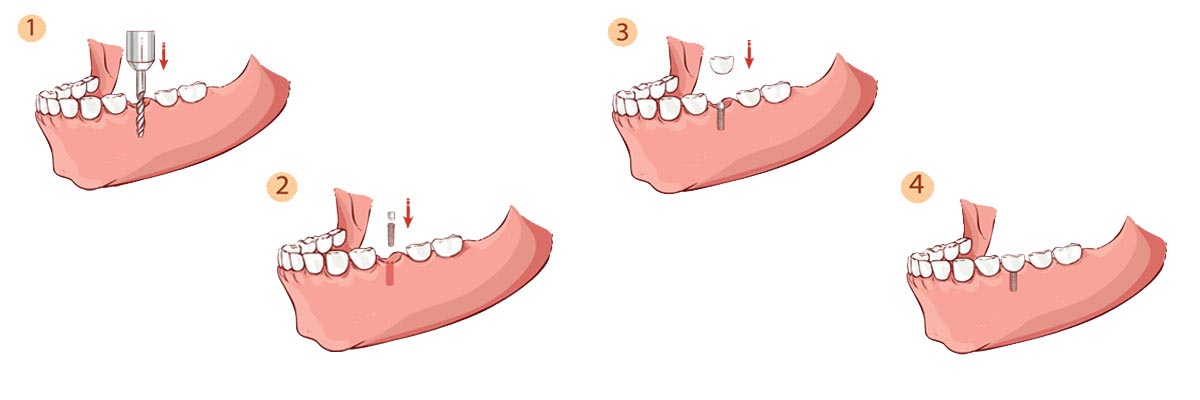 Portland The Dental Implant Procedure