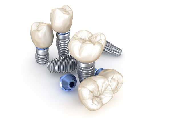 Dental Implant Restoration Portland, OR