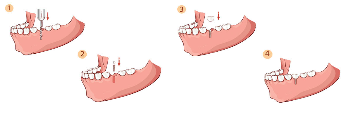 Portland Dental Implant Restoration