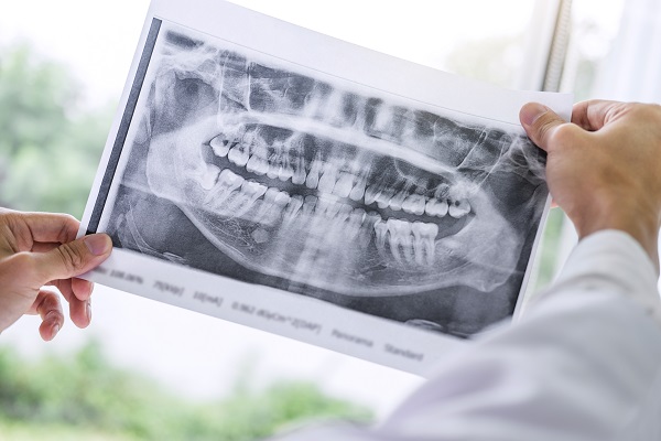 Dental Implant Restorations Portland, OR