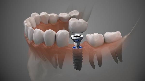 Dental Implants Portland, OR