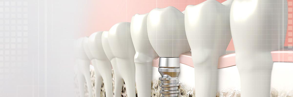 Portland Implant Dentist