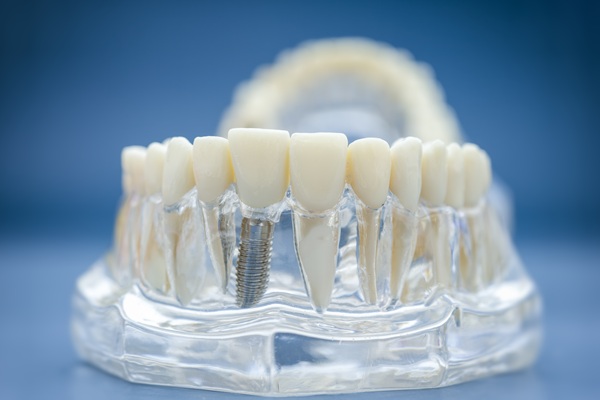 What To Consider When Choosing An Implant Restoration