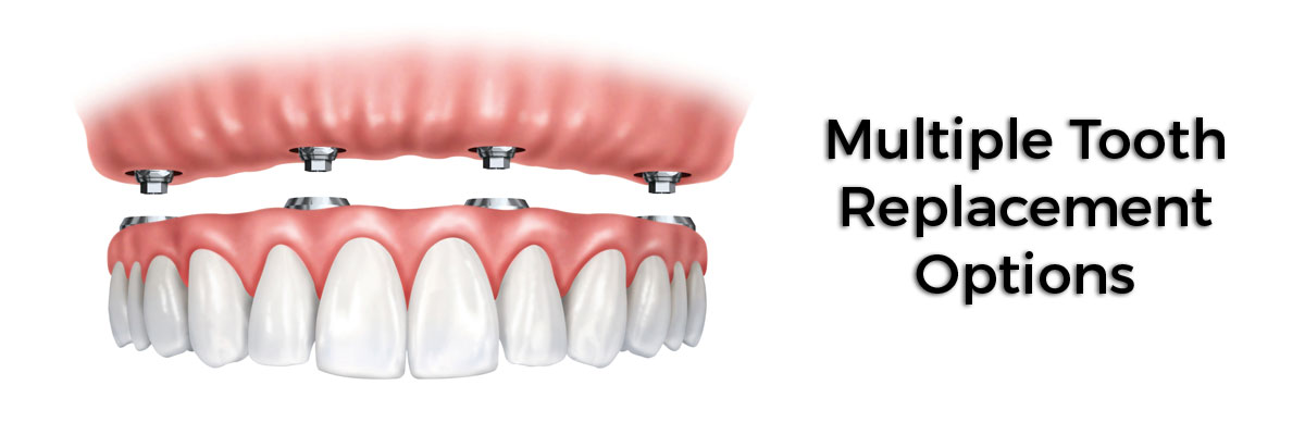 Portland Multiple Teeth Replacement Options