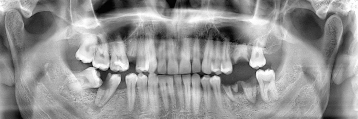 Portland Options for Replacing Missing Teeth